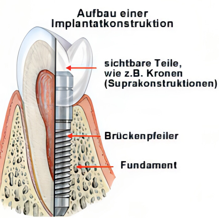 Implantate in der Zahntechnik